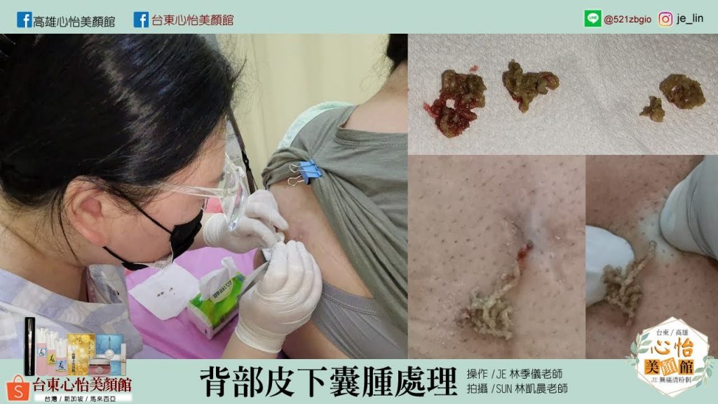 JE-背部皮下囊腫無痛處理-心怡美顏館-林季儀老師