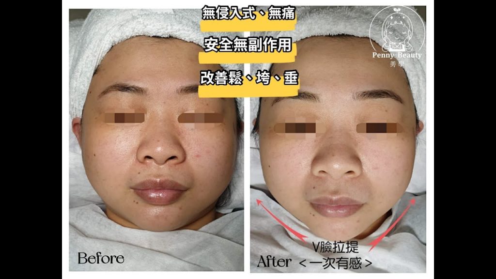 V臉逆齡拉提#台中做臉#V臉拉提#肌膚緊緻#一中做臉#改善鬆垮垂#黑眼圈