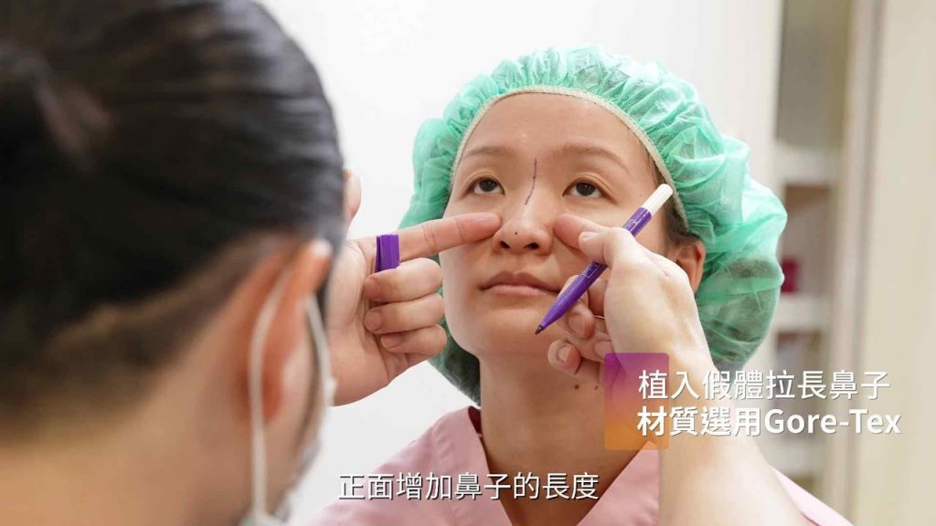 鼻整形隆鼻改善鷹勾鼻及駝峰的方式,網美鼻型設計重點在鼻頭 Dr.朱立箴醫師