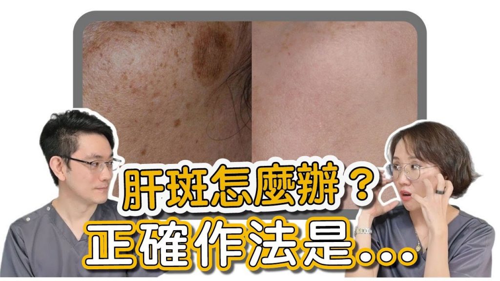 你有黃褐斑嗎?脫色雷射治療黃褐斑? !快來聽醫會診!