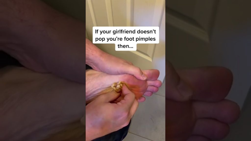 Cystic Acne Removal & Inflammatory Acne #acne #blackheads #cysticacne #shorts