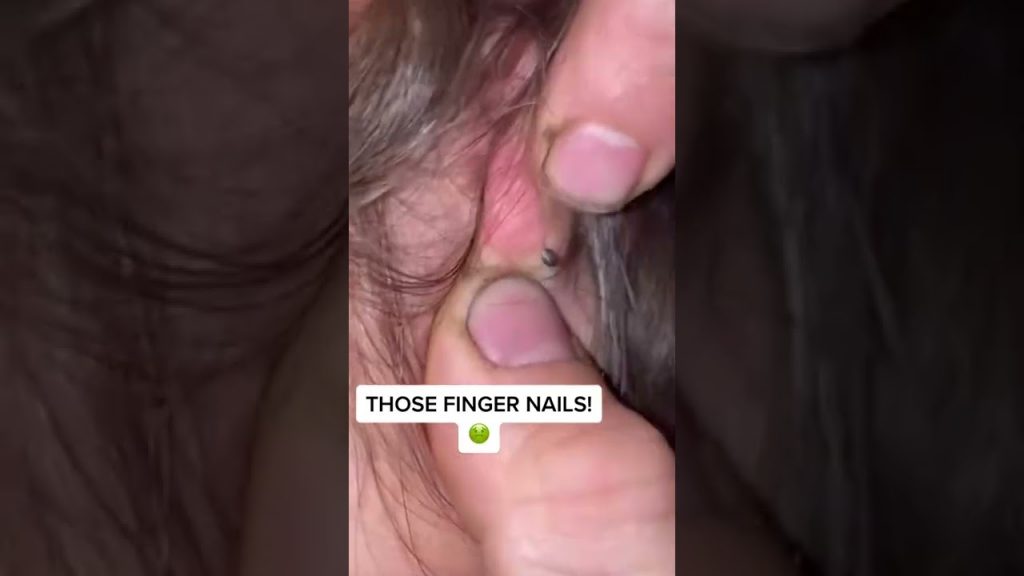 Cystic Acne Removal & Inflammatory Acne