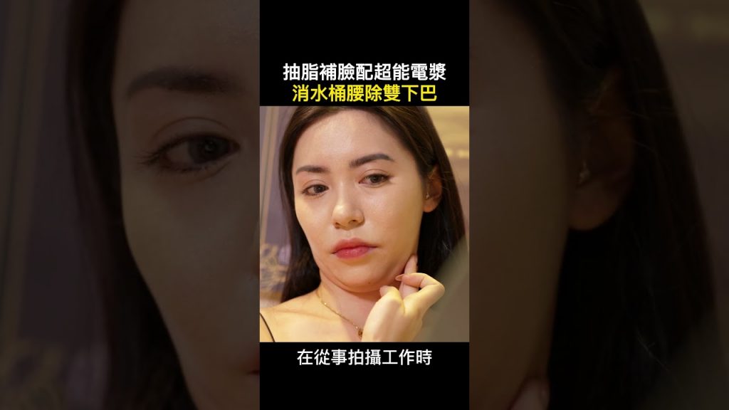 雙下巴和腰部贅肉怎麼處理?透過抽脂手術和超能電漿改善實測