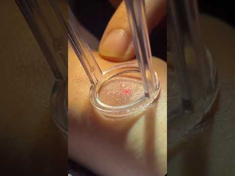 Up雷射&BBL治療增生性疤痕,疤痕淡化,美麗無瑕! #shorts