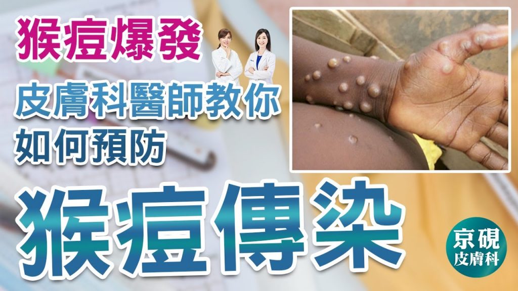 猴痘爆發!!!皮膚科醫師教你如何預防猴痘傳染。