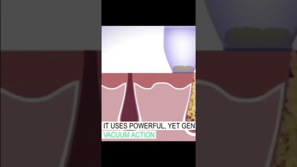 肌膚毛孔粉刺清潔器(6325)