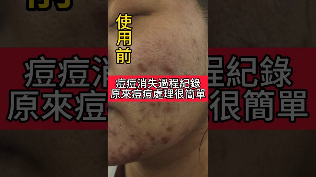 痘痘消失過程全記錄原來痘痘處理超級簡單! #保養品#保養#護膚品#痘痘#痘痘粉刺#shorts