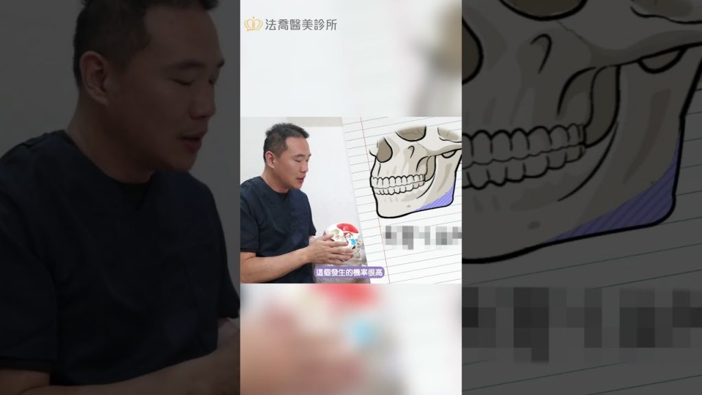 擦除邊角角,雕刻完成的下頜線!截骨術後有什麼注意事項嗎?有後遺症嗎? – 邱疏浚醫療隊