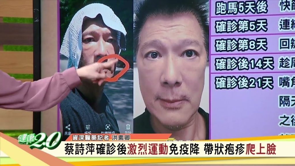 接種帶皮疹癲癇皮蛇上身健2.0