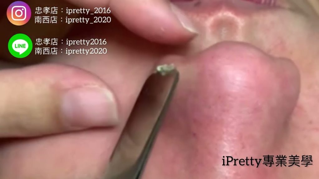 iPretty專業美學/黑頭粉刺打掃除/療癒黑頭粉刺/草莓鼻