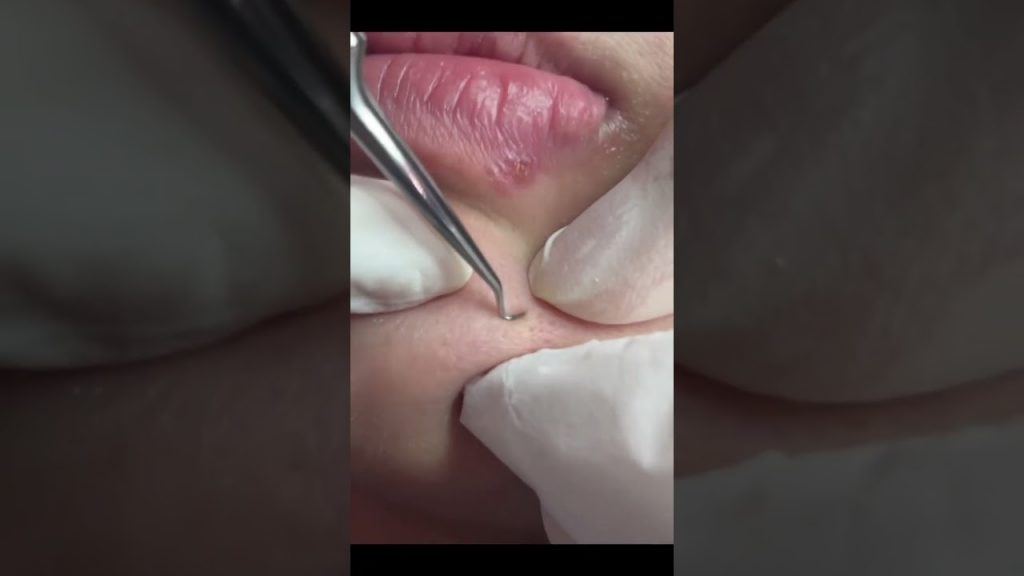 油痘肌膚的深層清潔護膚療程!水飛梭!還你乾淨透亮的膚況! #shorts