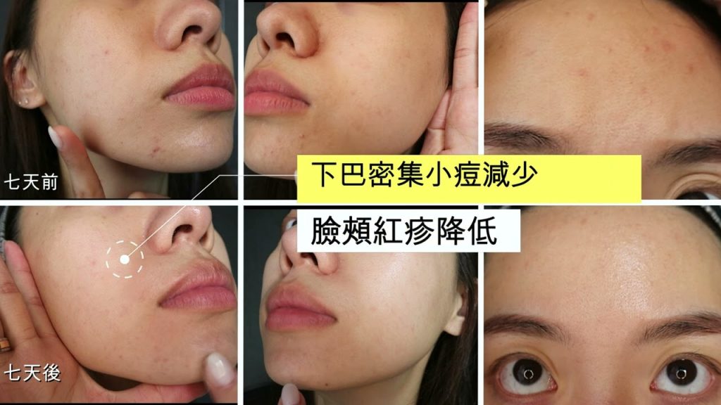 內分泌失調7天-實際改善| 天花|