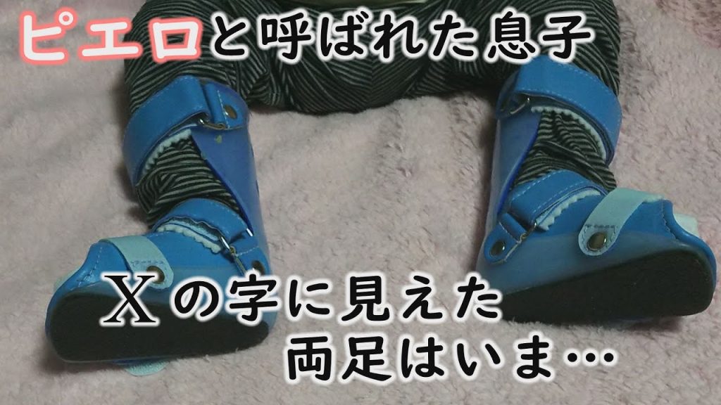 「くるぶしで立っていた」皮膚のかゆみだけでなく、両足の変形とも向き合う…~CBCテレビ定期配信型ドキュメンタリー「ピエロと呼ばれた息子」第58話#CBCドキュメンタリー