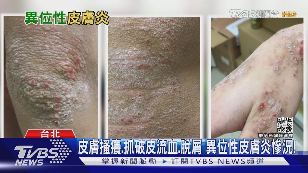 皮膚出現「三大症狀」全身抓流血.搔癢難耐…醫警告別做這件事…|十點不一樣20220715