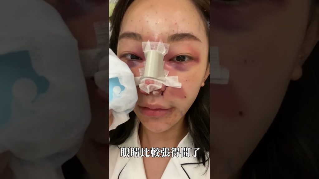 整形一個月恢復|福爾思庭