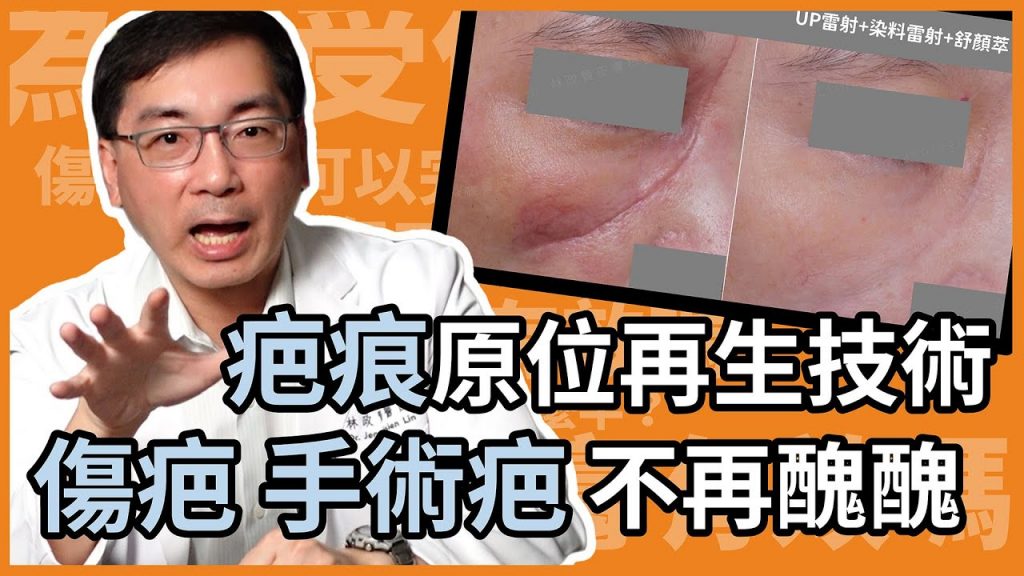 疤痕原位再生技術能改善傷疤、手術疤,結合UP 雷射及其他治療,可大幅改善疤痕外觀!皮膚科林政賢醫師一次告訴你疤痕救星!