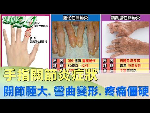 手指關節發炎!關節腫脹.變形.疼痛僵硬.健康2.0。