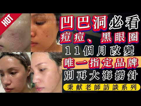 天麗生技|0608期|從萬元預算到改變全家膚況【台東超愛美Dina】凹疤洞~痘痘~黑眼圈‼ ️|秉獻老師訪談系列|【家羚顧問體系🏆年度業績成長最快團隊】肌膚諮詢/輔導創業LINE🔍@865eiwjx