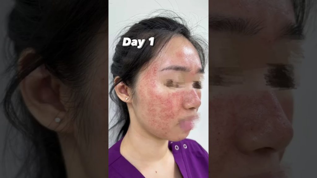 皮秒雷射術後修復需要幾天? #shorts