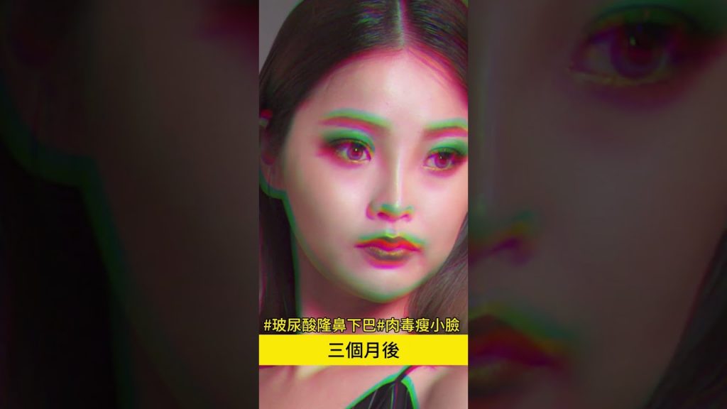 玻尿酸隆鼻與肉毒瘦小臉,Mini的微整形心得日記分享 台中教主