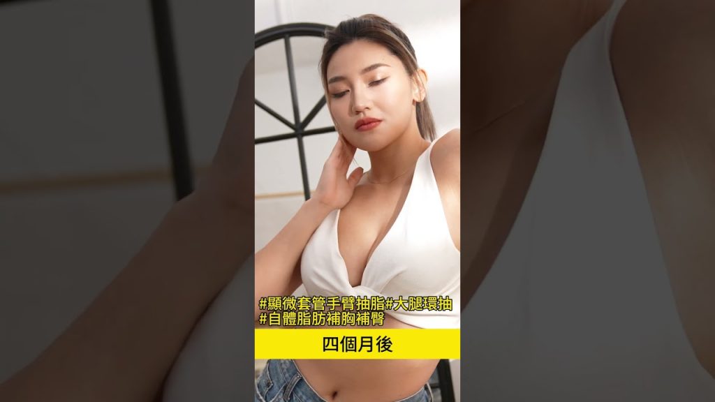 顯微套管抽脂蝴蝶袖+威塑大腿環抽+補胸補臀 台北教主 吳孟頴醫師