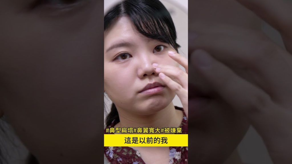 蒜頭鼻透過鼻整形隆鼻手術讓鼻子變精緻了 台北教主 朱立箴醫師