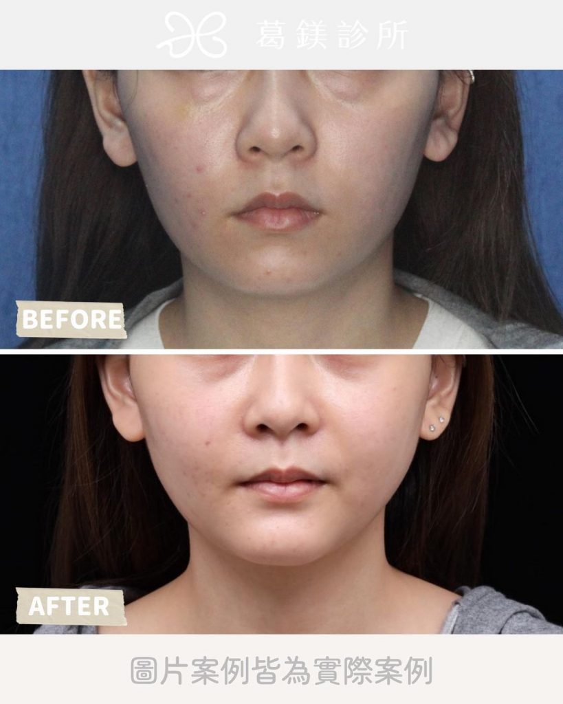 葛鎂診所|天生骨架大
80%的人都有的困… | Ibeauty