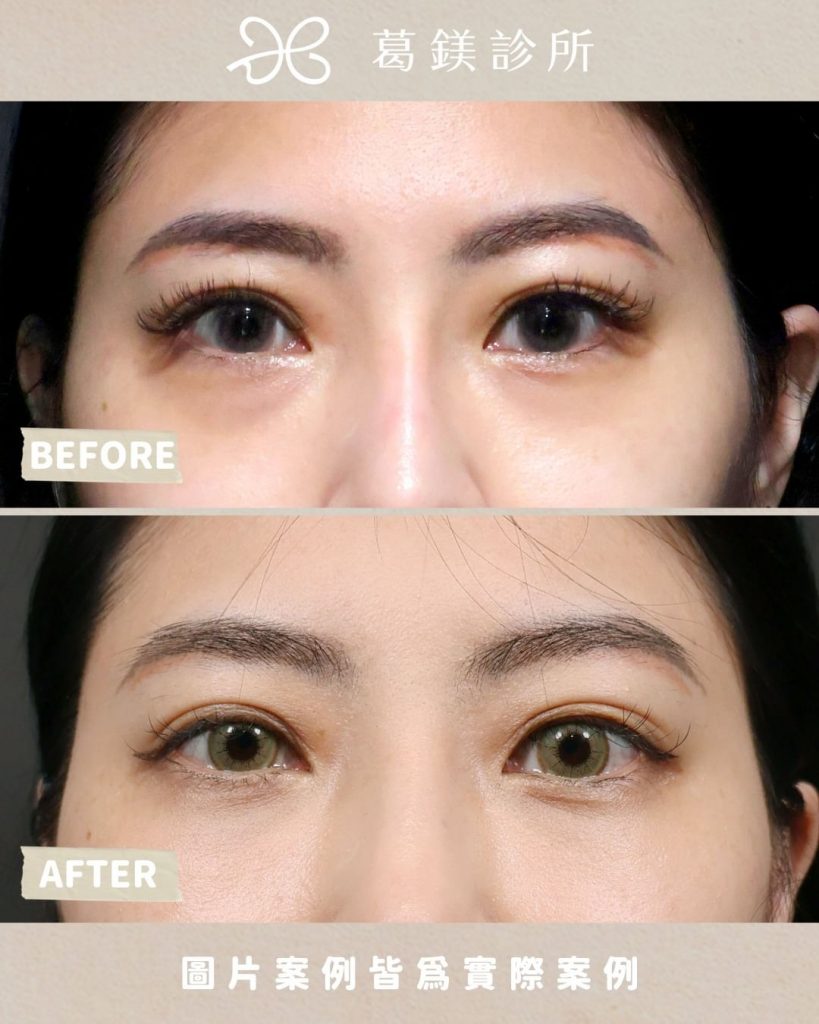 葛鎂診所|改善深眼袋
保持清潔感跟俐落感… | Ibeauty