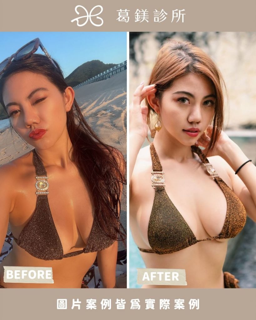 葛鎂診所|女王波
同一件比基尼、不同心情… | Ibeauty