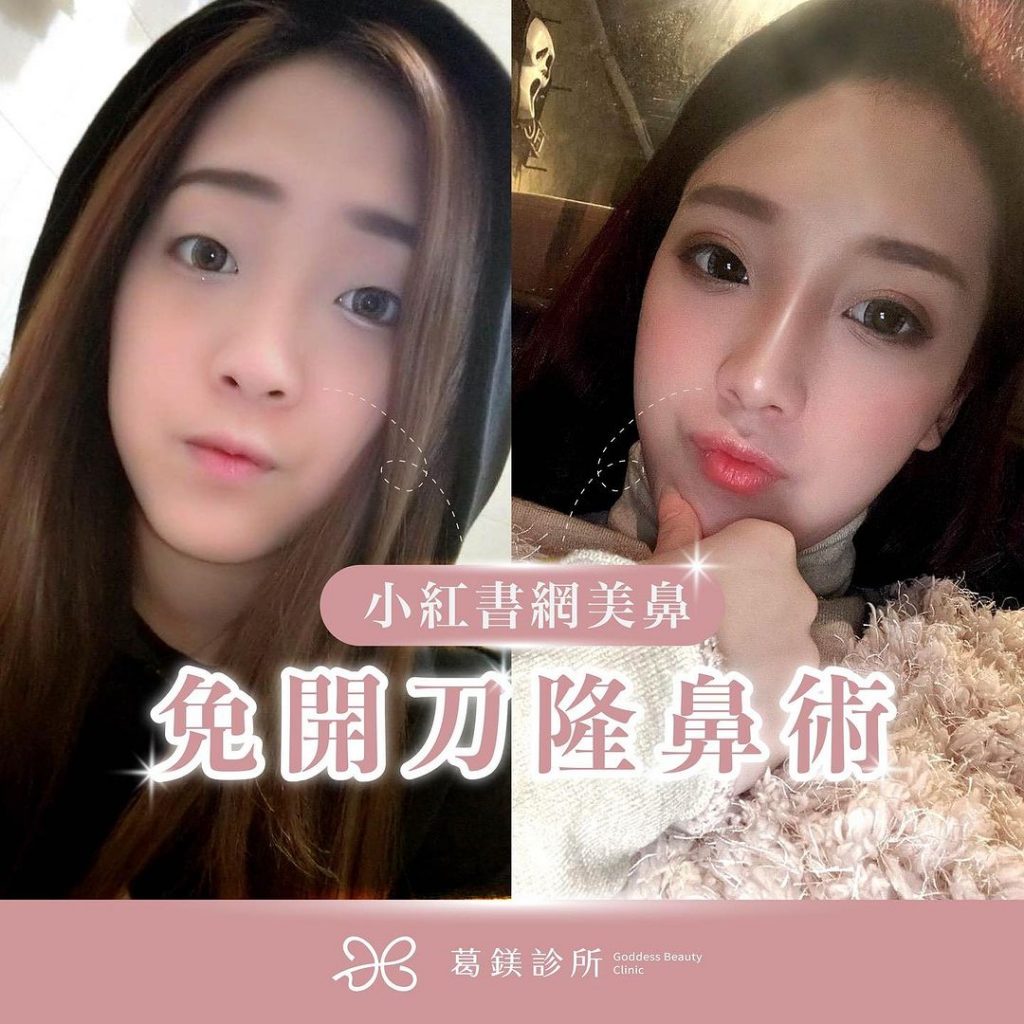 免開刀隆鼻術
|免動刀恢復期短|
|… | Ibeauty