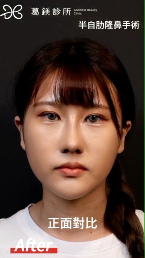 驚調整一個五官改變整張臉
顧客選擇半自… | Ibeauty