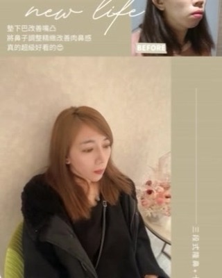這次調整鼻子跟下巴能差多少照片告訴你
… | Ibeauty