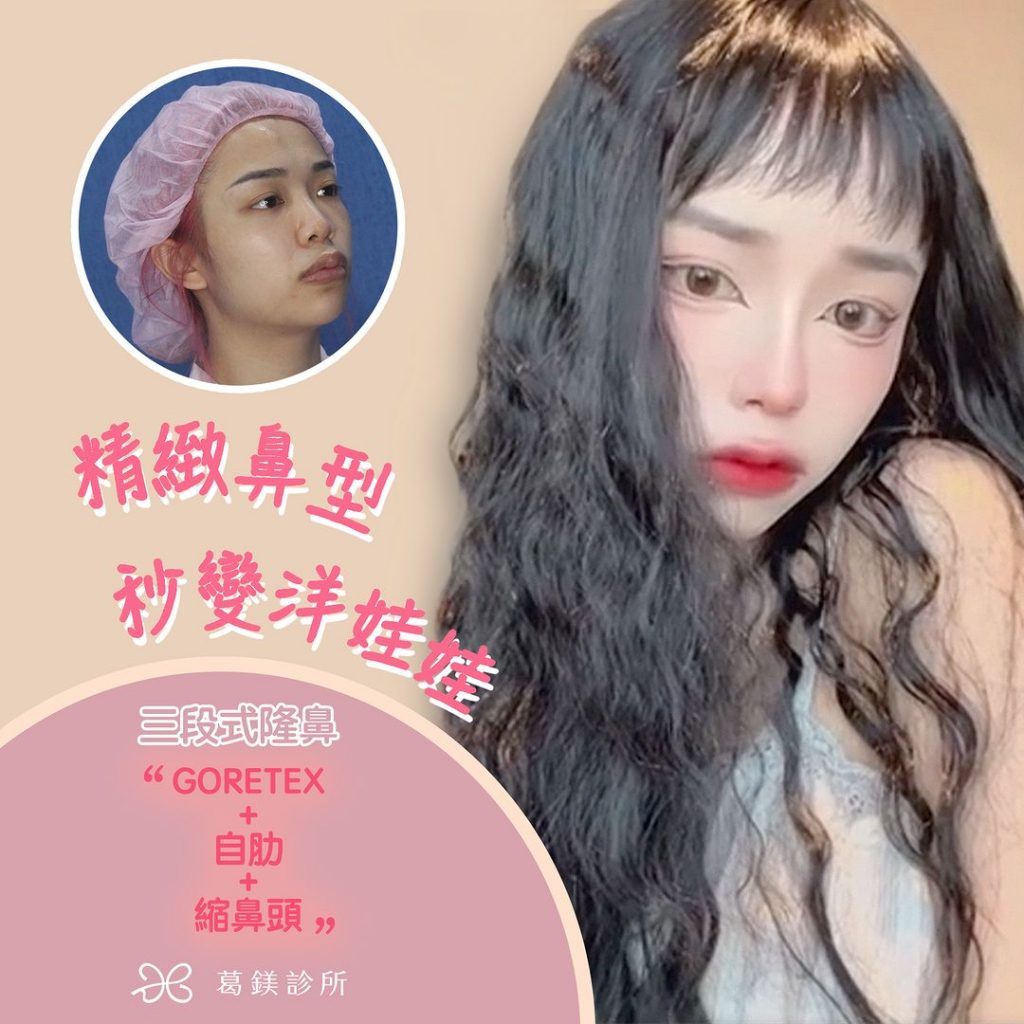 揮別過去秒變洋娃娃
選擇三段式隆鼻
… | Ibeauty