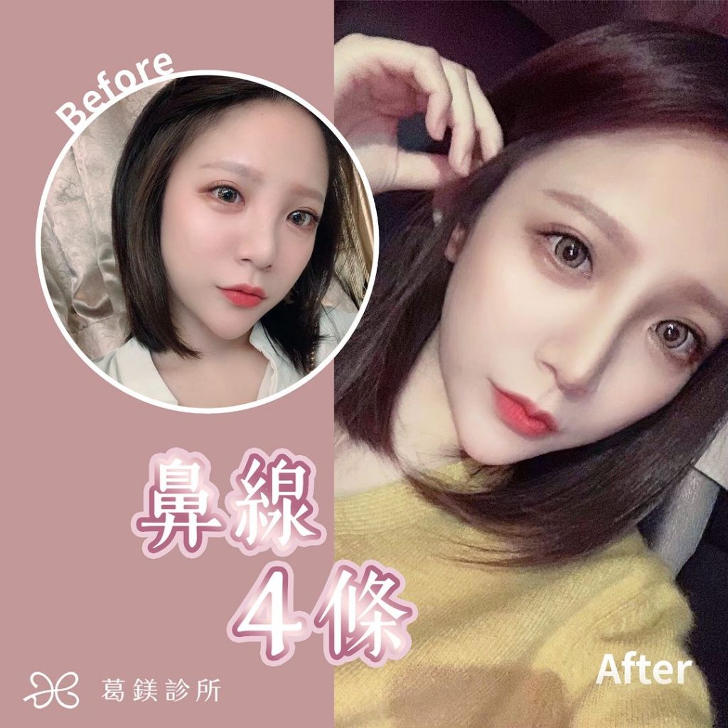 4D立體鼻埋線-非常適合想先看看
自己… | Ibeauty