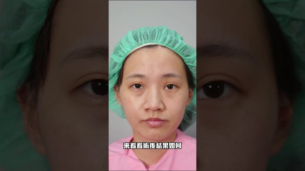 客製化結構式網美鼻型設計三段式隆鼻 台北教主醫美整形 Dr.朱立箴醫師